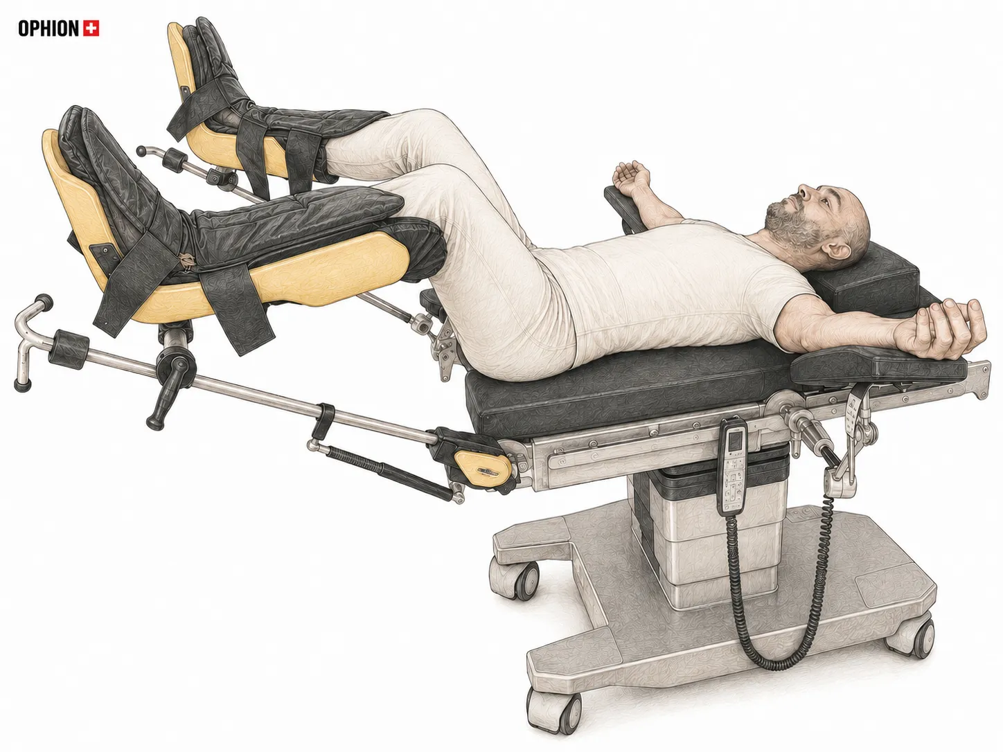 Steinschnittlage im OP mit angehobenen Beinen in Beinstützen – Lithotomy Position und OPHION Patientenlagerung